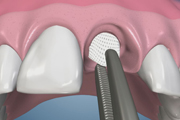 Cytoplast Mem and Ridge Preservation for Bridge